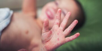 Regenperiode gunstig voor uitbraak ziekte onder kinderen