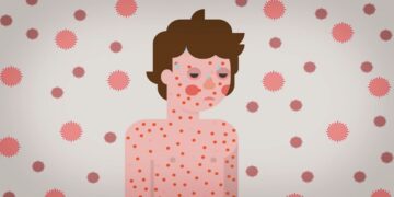 mazelen Volgens de laatste epidemiologische update van de Pan American Health Organization (PAHO) zijn medio juni 2025 in totaal 7.132 bevestigde gevallen van mazelen en 13 sterfgevallen gemeld in de regio van Noord- en Zuid-Amerika. Dit is een 29-voudige stijging ten opzichte van de 244 gevallen die in dezelfde periode in 2024 werden gemeld...