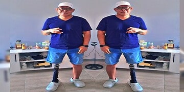 arthy twinning Sama-An leeft sinds zijn jeugd met diabetes mellitus. Wat begon als een ogenschijnlijk onschuldige eeltvorming onder zijn linkervoet, groeide uit tot een ernstige medische situatie. Door slechte wondgenezing – een bekend risico bij diabetespatiënten – ontstonden complicaties die uiteindelijk leidden tot een amputatie van zijn linkerbeen boven de knie. Hij was toen 39 jaar.